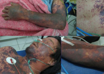 Bệnh do liên cầu khuẩn lợn (Streptococcus Suis Infection in Pigs)